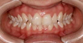 invisalign-before2