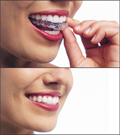 Invisalign - removable braces